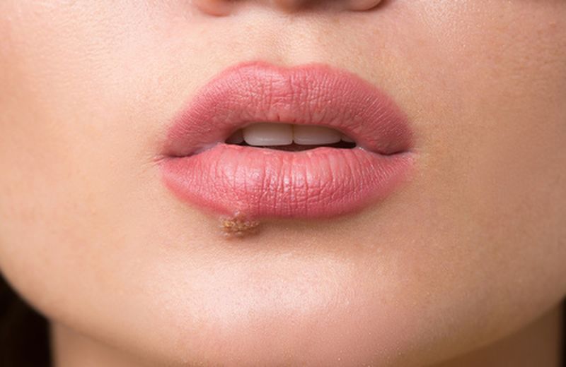 cliomakeup-cosa-c'è-sotto-le-unghie-10-herpes