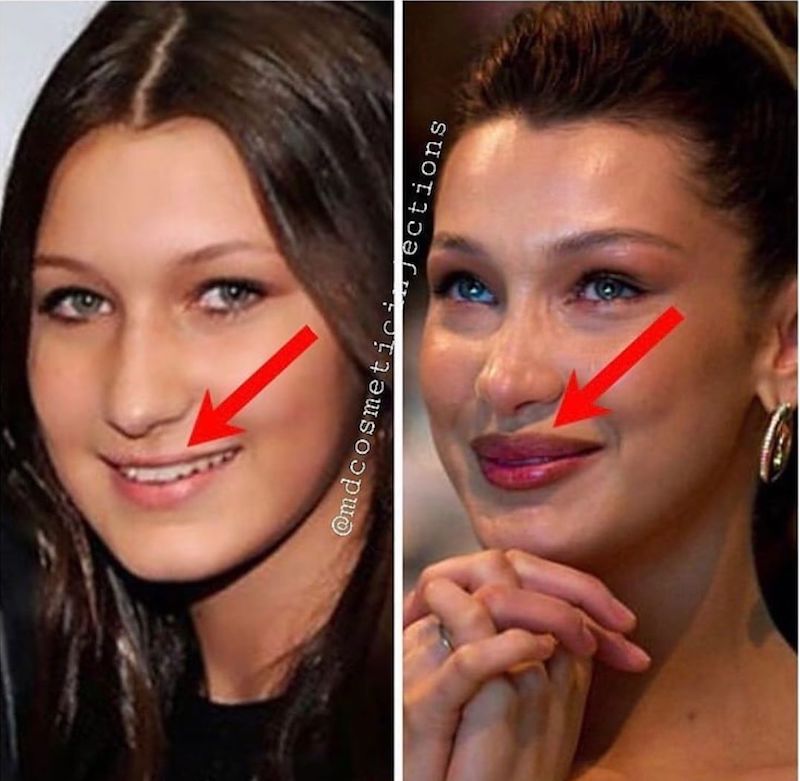 cliomakeup-bella-hadid-prima-e-dopo-teamclio-chirurgia