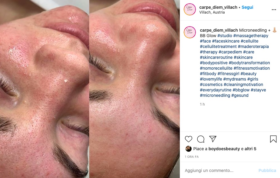 Cliomakeup-dermaroller-usi-domande-8-microneding-naso