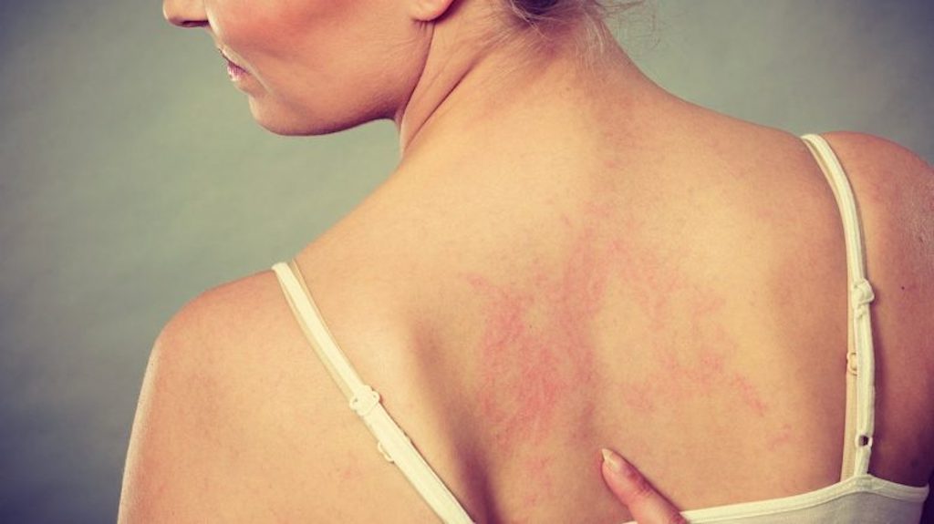 cliomakeup-irritazione-da-sudore-1