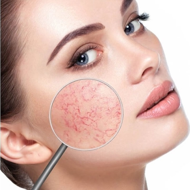 cliomakeup-couperose-13-capillari