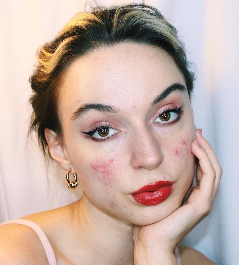cliomakeup-couperose-teamclio-rosacea