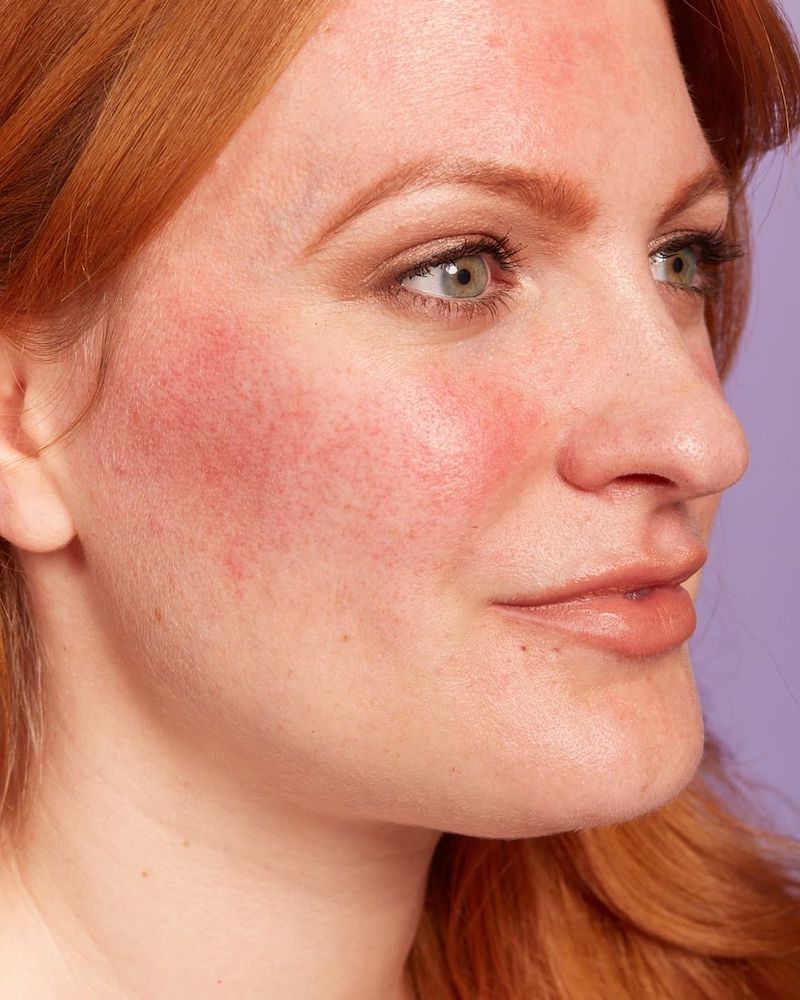 cliomakeup-couperose-teamclio-rosacea2