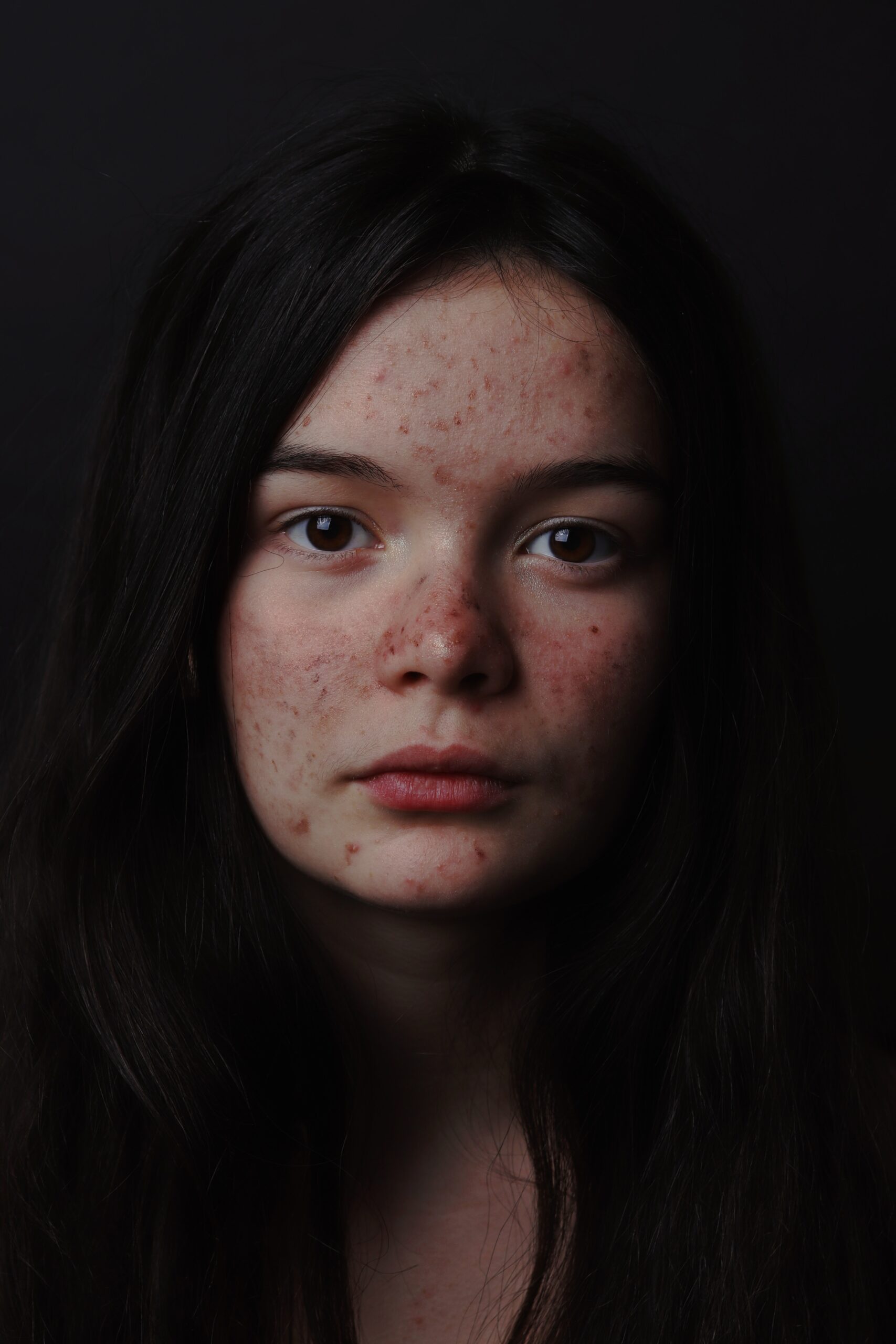 Cliomakeup-quale-esfoliazione-scegliere-pelle-acne