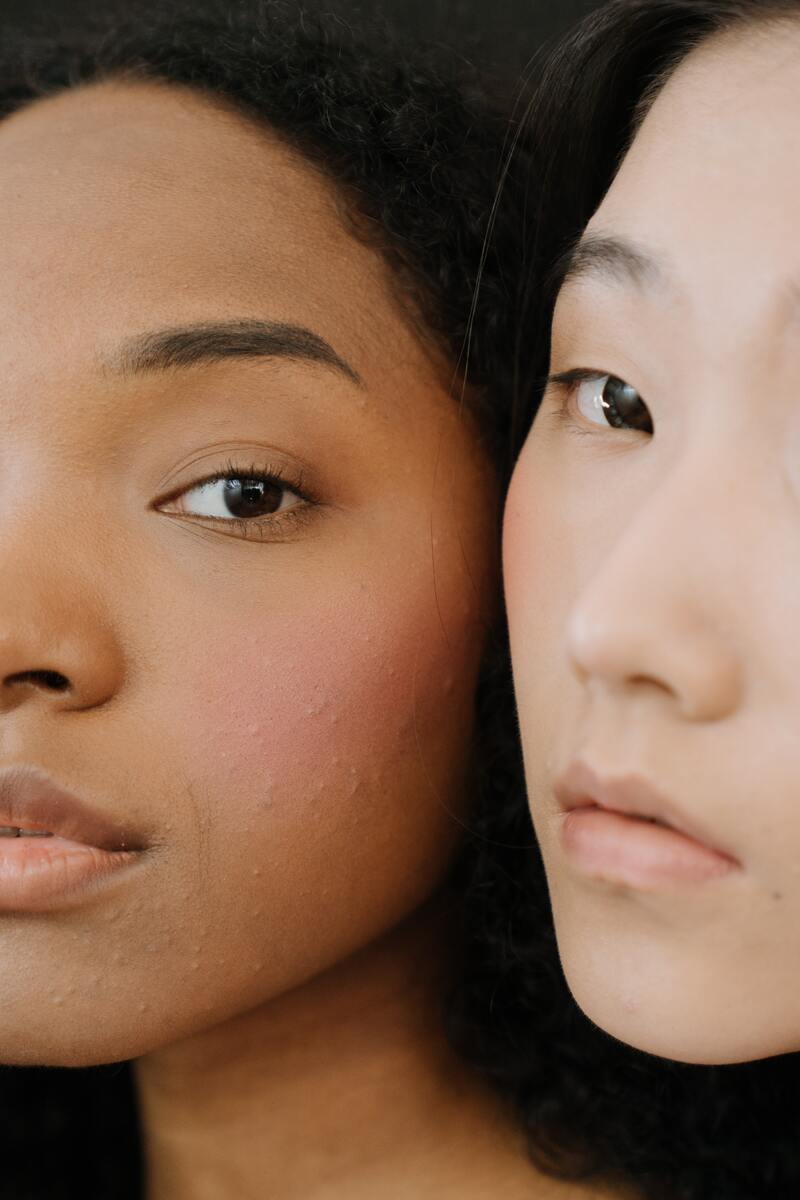 cliomakeup-acne-da-sole-brufoli-sottopelle