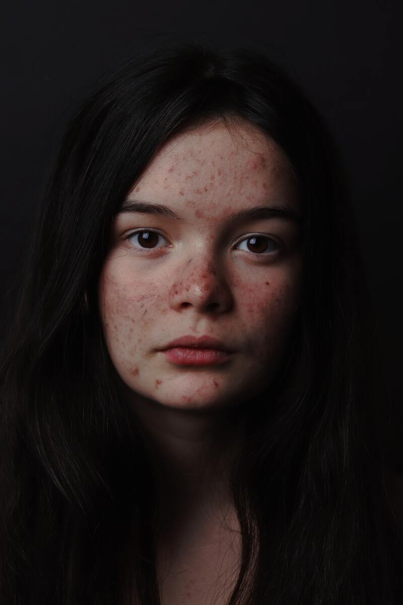 cliomakeup-olio-di-marula-acne