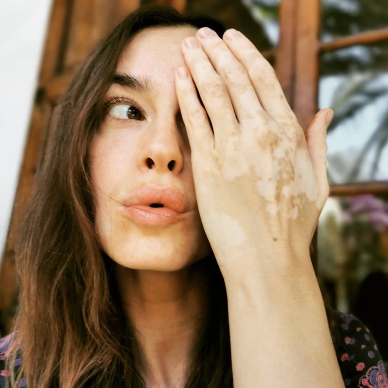 cliomakeup-star-con-vitiligine-kasia-smutniak-mano