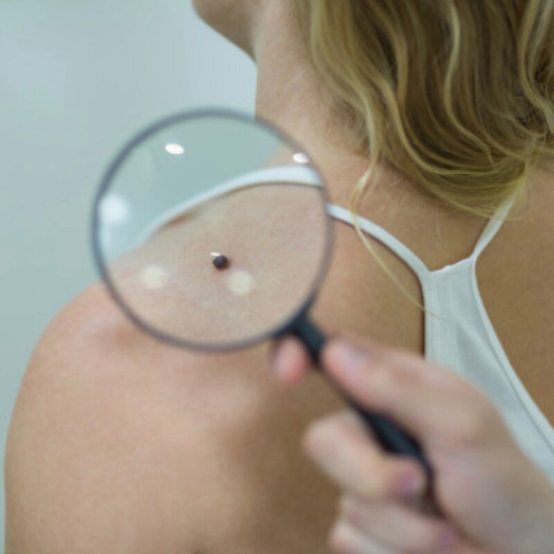 cliomakeup-melanoma-prevenzione