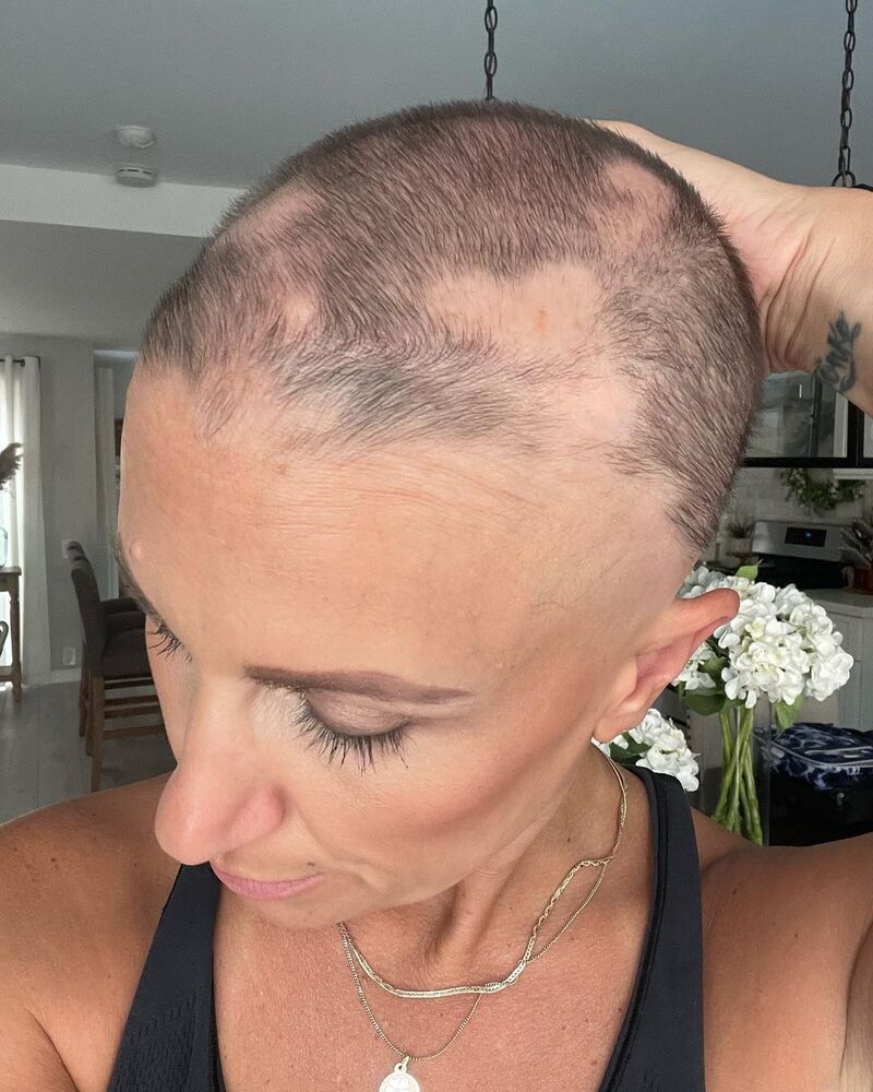 cliomakeup-alopecia-areata