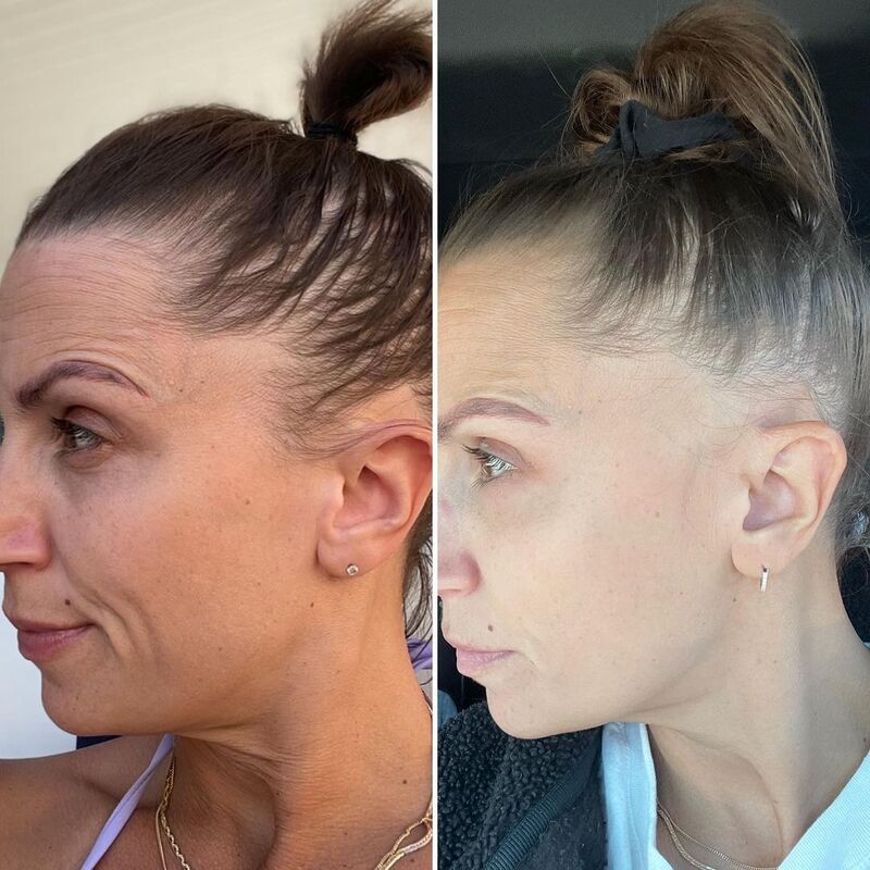 cliomakeup-alopecia-perdita-capelli