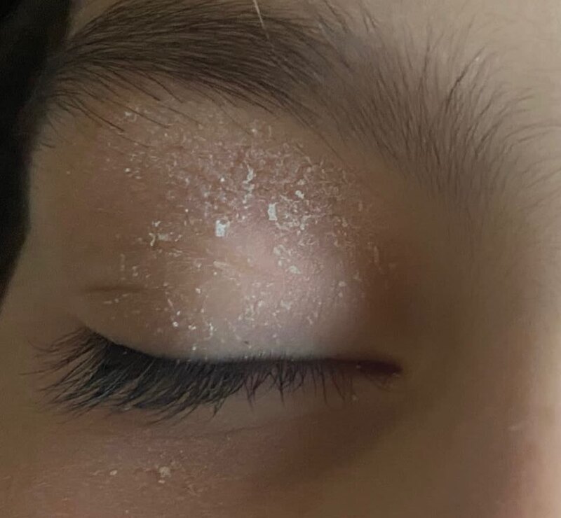 cliomakeup-dermatite-atopica-pelle-secca