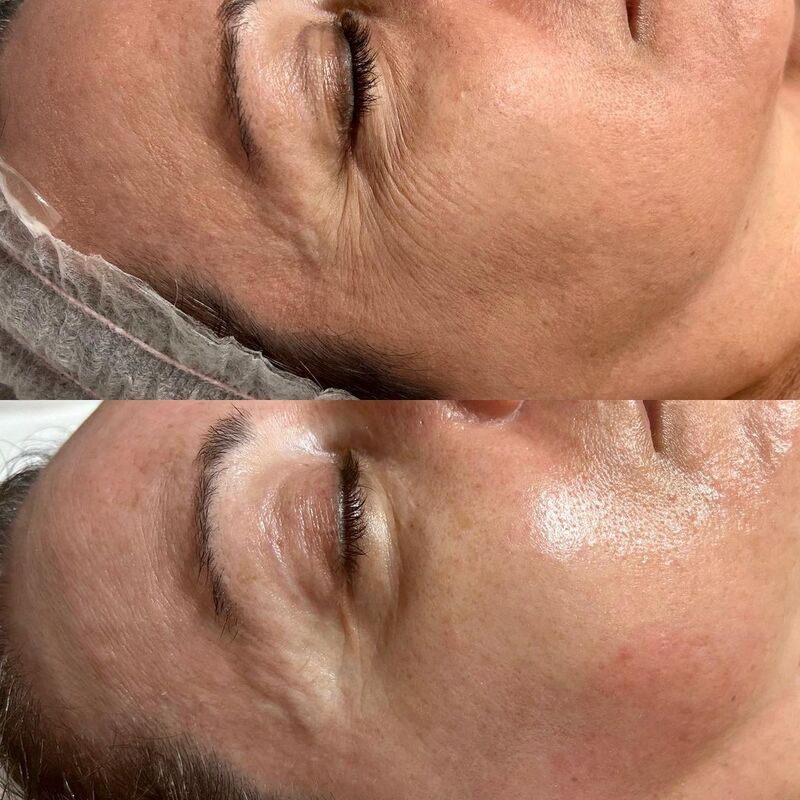 cliomakeup-radiofrequenza-viso-prima-dopo