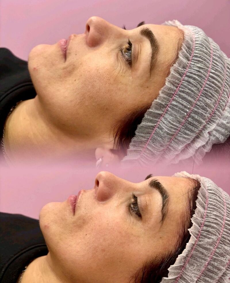 cliomakeup-radiofrequenza-viso-risultati