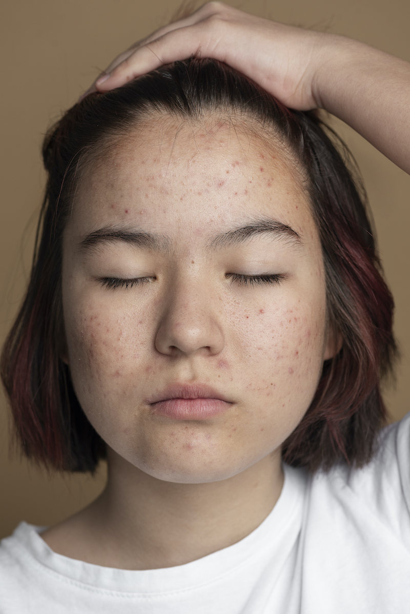 cliomakeup-skin-purging-4