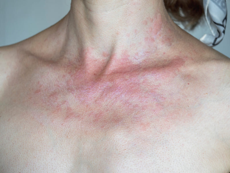 cliomakeup-scottature-cuoio-capelluto-vescicole