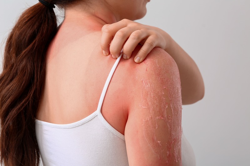 cliomakeup-come-scegliere-spf-scottature