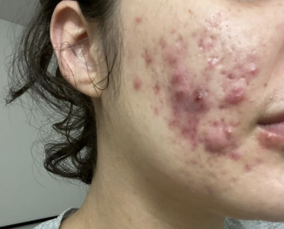 come-usare-cicaplast-la-roche-posay-modi-sfruttare-benefici-cicatrici-da-acne