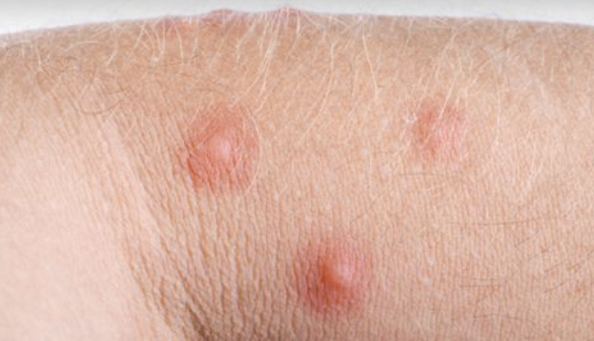come-usare-cicaplast-la-roche-posay-modi-sfruttare-benefici-bambini-zanzara-puntura