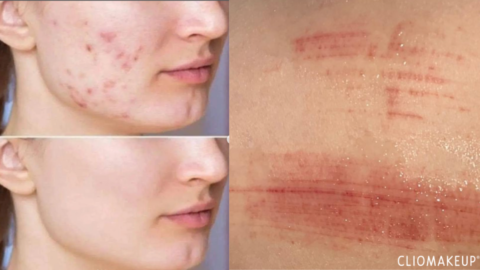 come-usare-cicaplast-la-roche-posay-modi-sfruttare-benefici-cicatrici