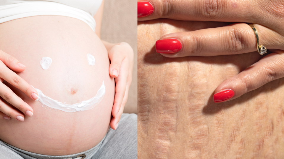 come-usare-crema-idratante-corpo-viso-smaglaiture-gravidanza